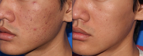 FACE PEEL, CHEMICAL PEEL , BEFORE AND AFTER