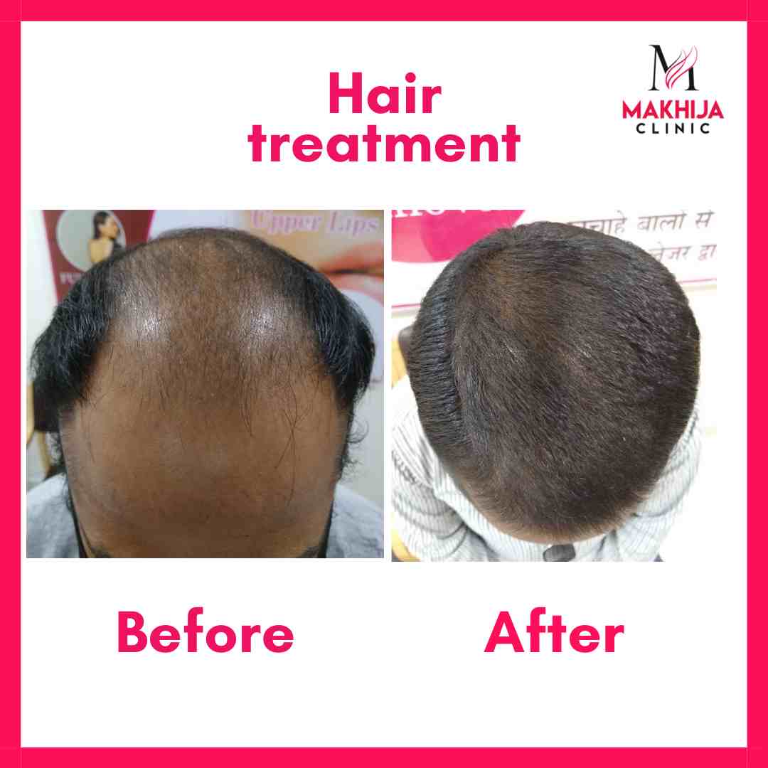 Hair growth treatment